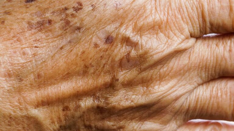 gunde 1 kez surun yaslilik lekelerini goturun vTT5nEhi.jpg